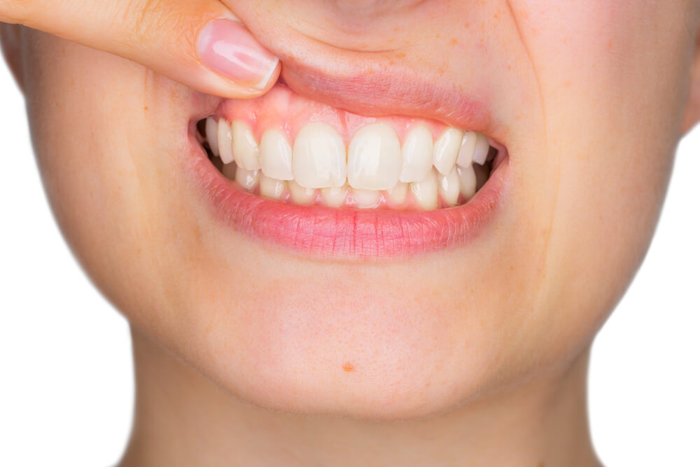 Diş Eti Hastalıkları Tedavileri (Periodontoloji)