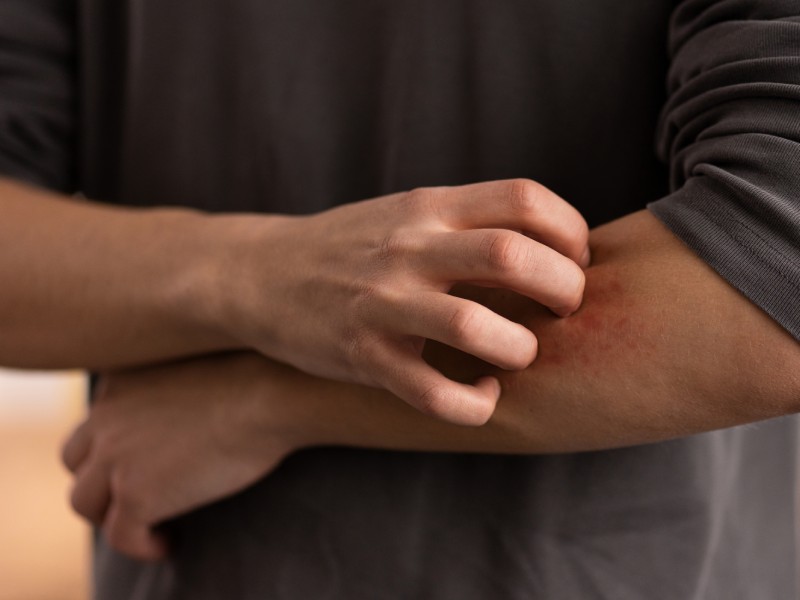 Lyme Hastalığı Nedir ve Belirtileri Nelerdir?